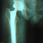 Replaced Hip Joint