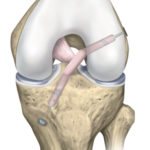 knee-arthroscopy-2