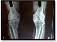 partial knee replacement