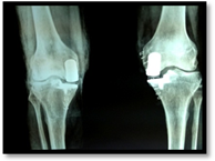 partial knee replacement