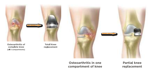 partial-knee-replacement