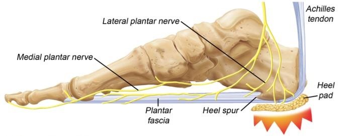 PLANTAR FASCIITIS (HEEL PAIN) | UDAI OMNI HOSPITAL